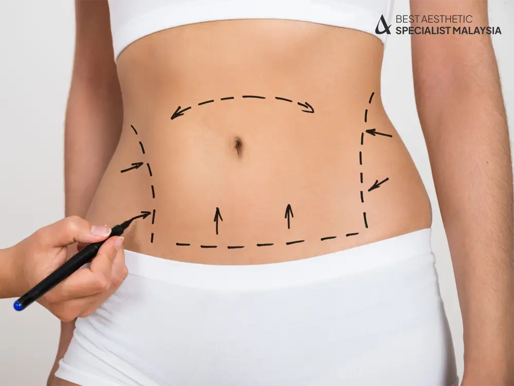 Liposuction in Malaysia: Understanding the Procedure, Benefits, and What to Expect