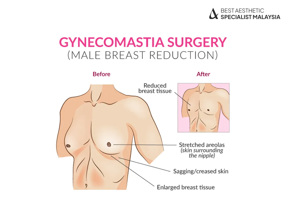 Gynecomastia Surgery Costs in Asia: Why Malaysia Is the Best Choice