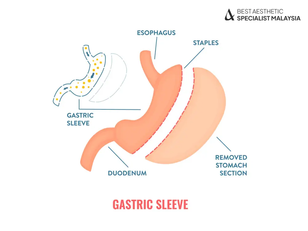 Navigating Life After Bariatric Surgery: Tips for Successful Weight Loss in Malaysia