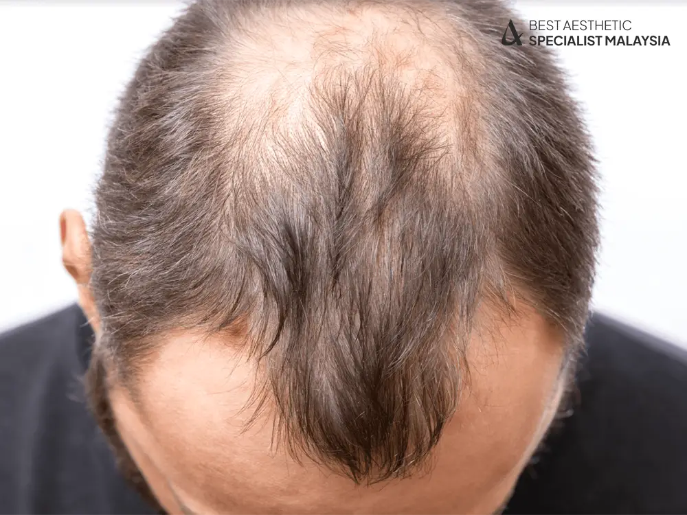 Hair Transplants : Hair Loss Ultimate Guide in Malaysia