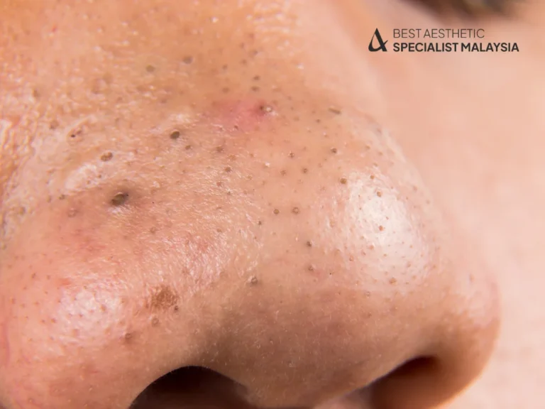 blackheads