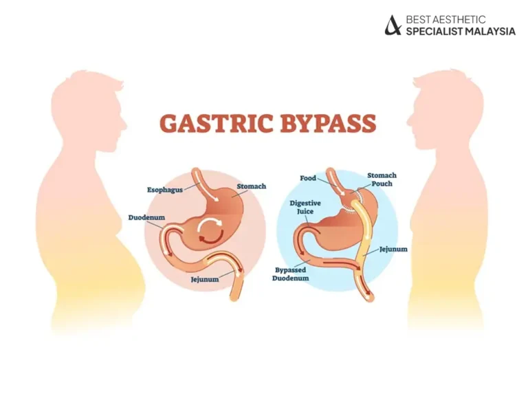 gastric-bypass-surgery-bariatric-malaysia-kuala-lumpur-aesthetic-clinic