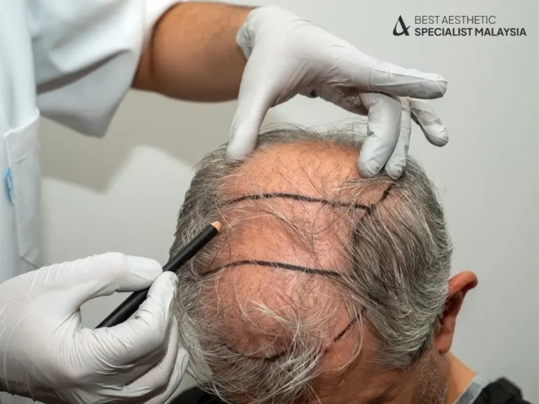 hair-transplant-procedure-malaysia-aesthetic-clinic-kuala-lumpur