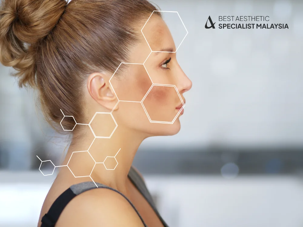 hyperpigmentation