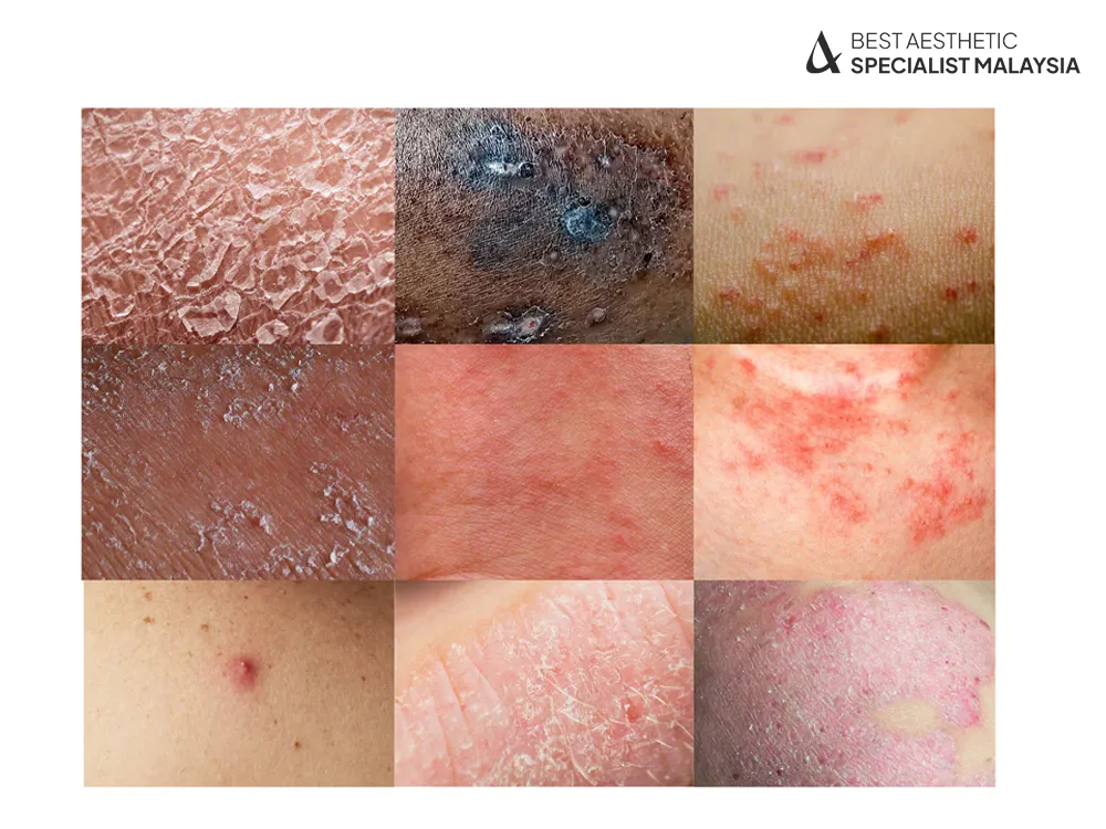 eczema-skin-aesthetic-clinic-kl-malaysia-2