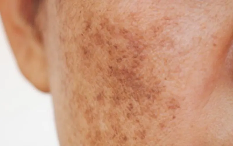 Pigmentation Treatment for Clear, Even-Toned Radiant Skin