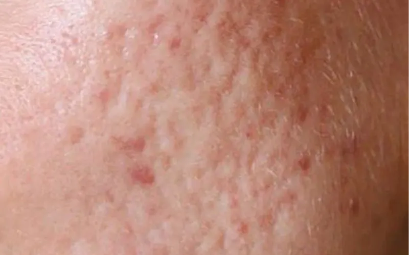 Types of Acne Scar Treatment in Malaysia