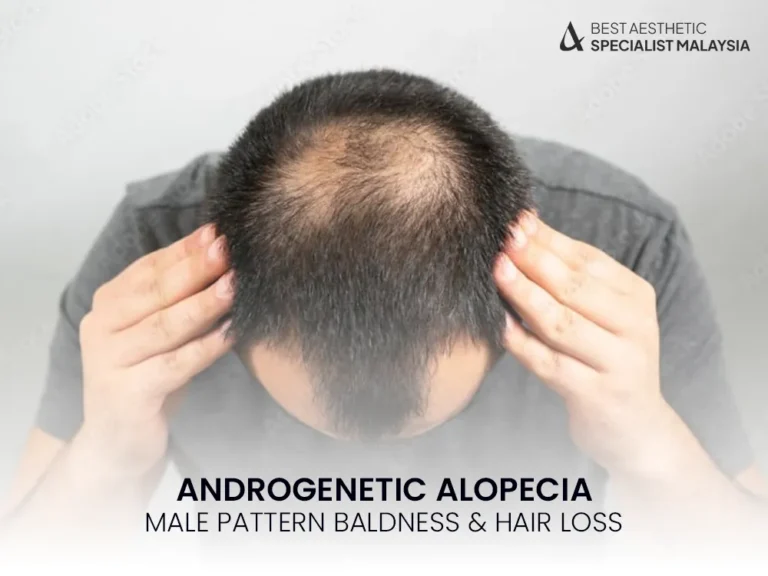 androgenetic-alopecia-men-balness-male