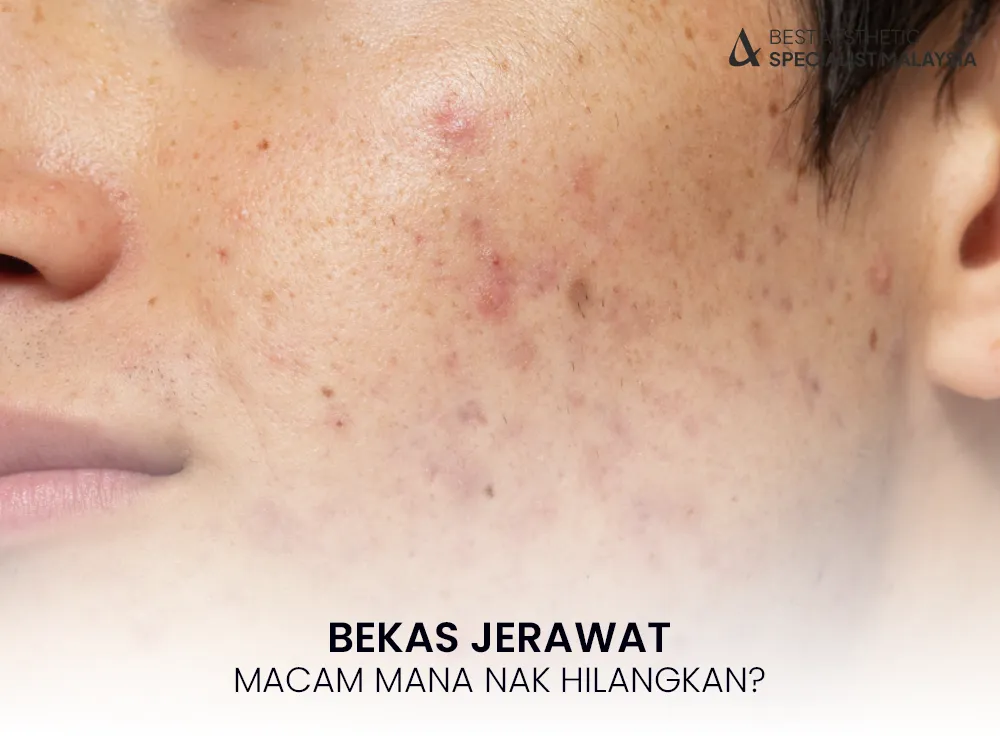 bekas-jerawat-cepat-hilang-1