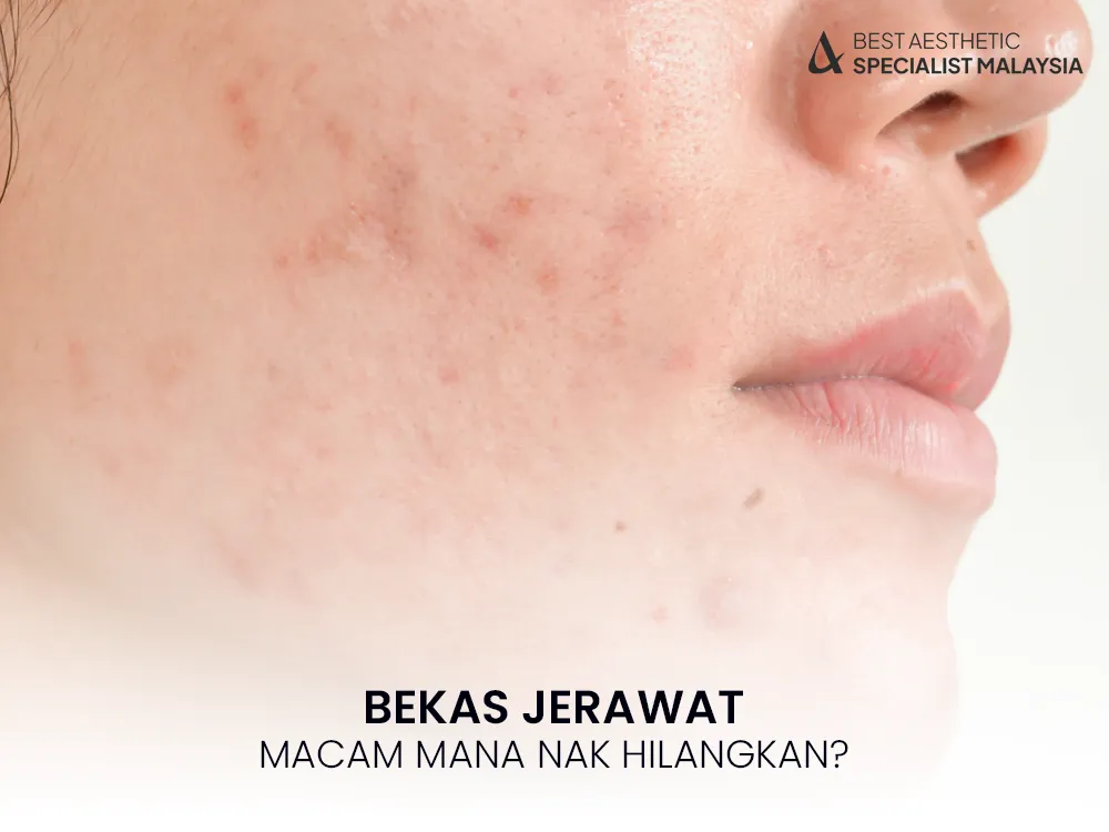 bekas-jerawat-cepat-hilang