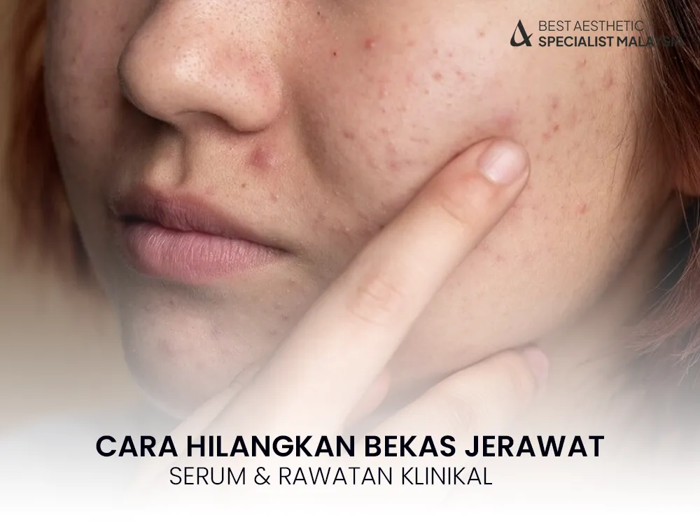 cara-hilangkan-bekas-jerawat-hitam-pipi-2025-2