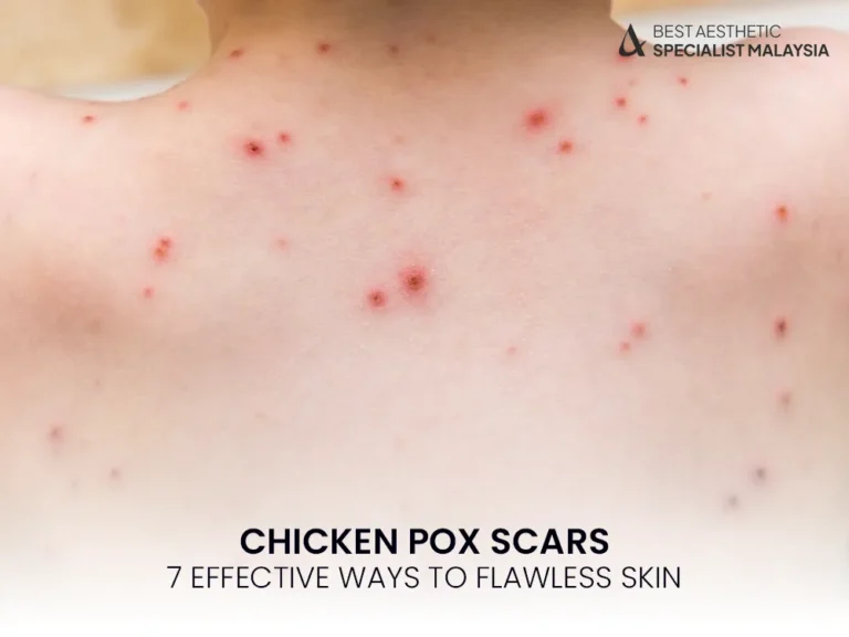 chicken-pox-scars-treatments