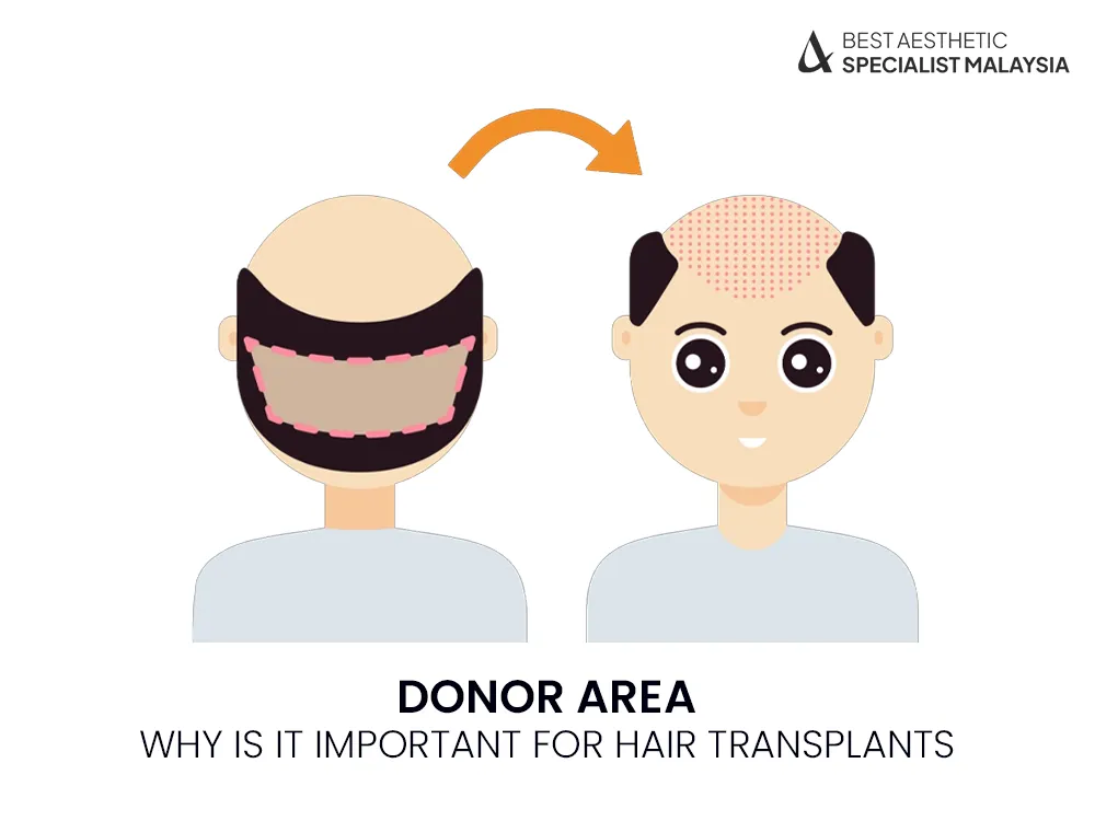 donor-area-hair-transplants