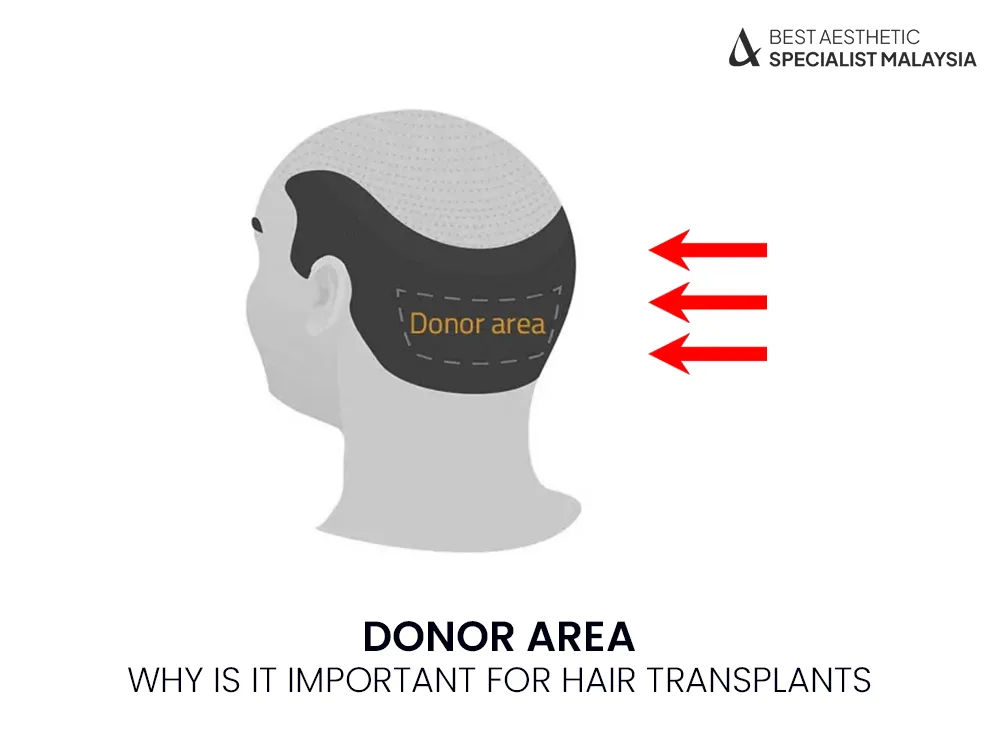 donor-area