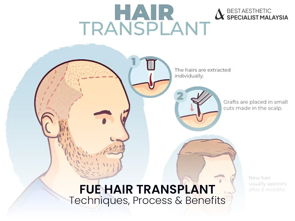 fue-hair-transplant