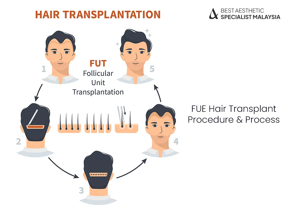 FUE Hair Transplant in Malaysia – Safe, Effective & Clinically Proven