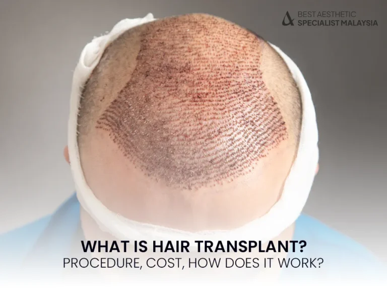 hair-transplant-procedure-cost-malaysia