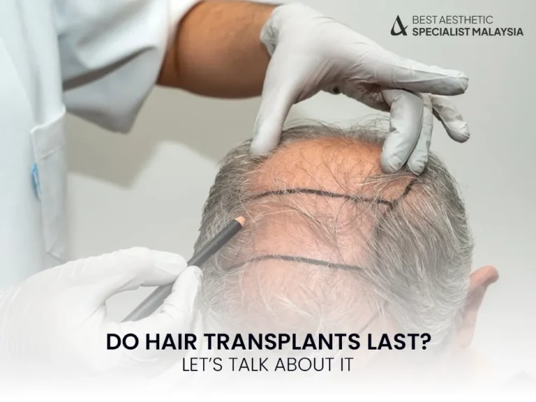 hair-transplants-how-long-do-it-last