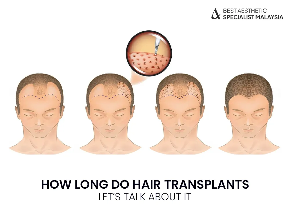 hair-transplants-how-long-do-it-last-malaysia