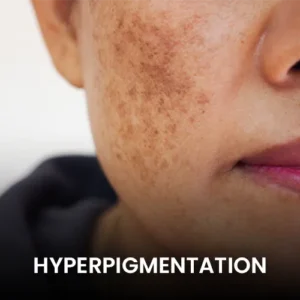 hyperpigmentation pico laser