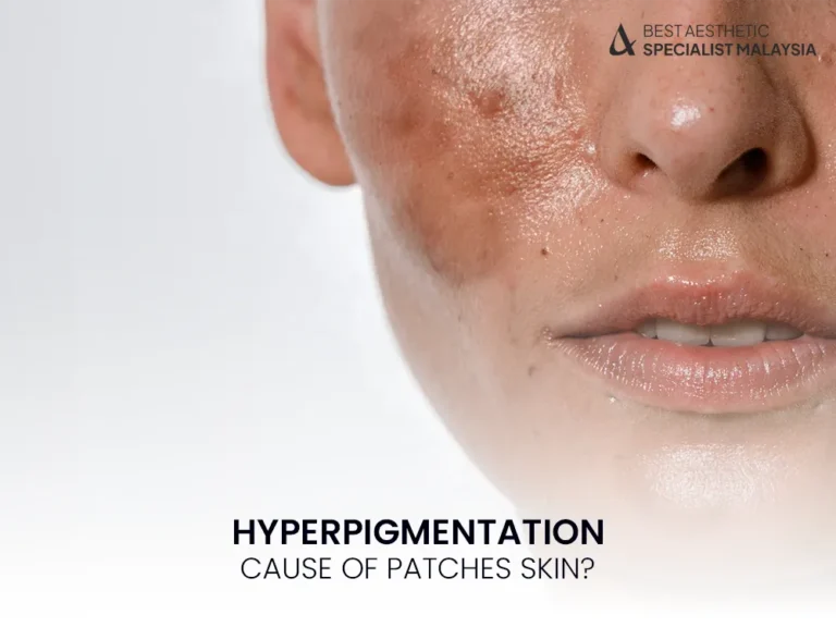 hyperpigmentation-skin-patches-dark-1