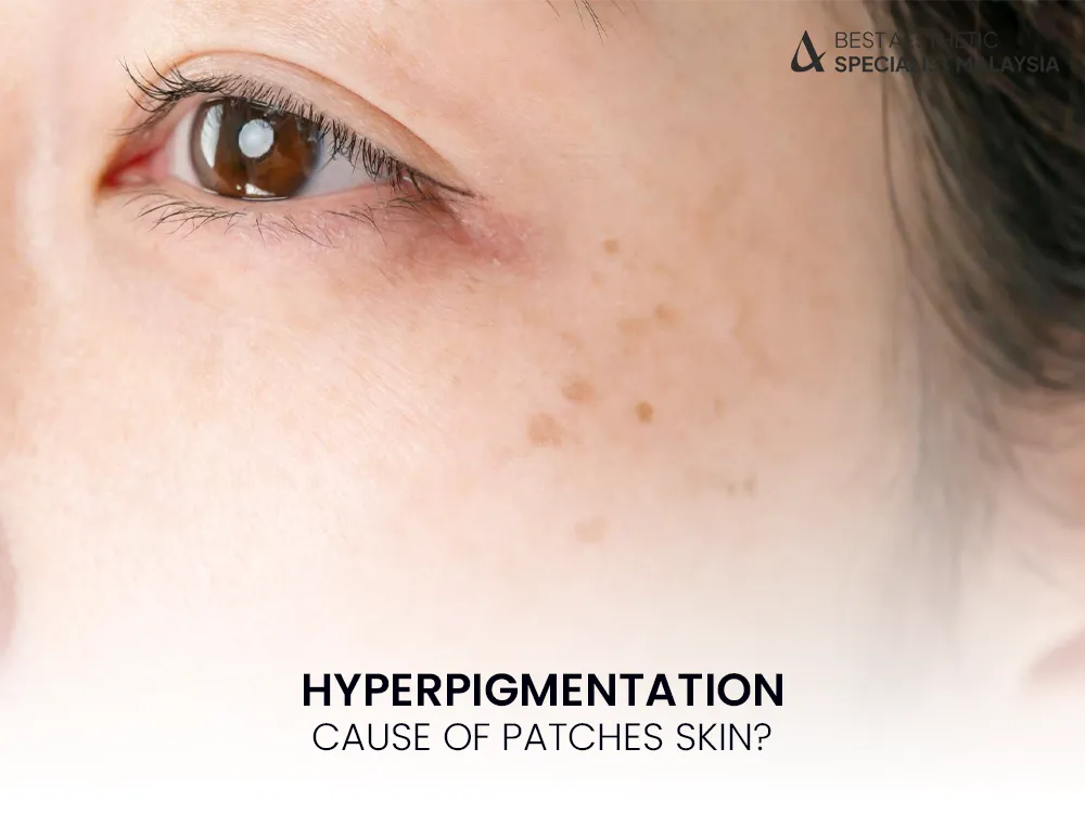 hyperpigmentation-skin-patches-dark