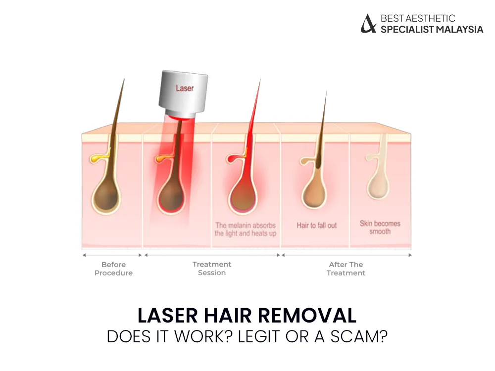 laser-hair-removal-process