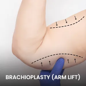 liposuction-armlift