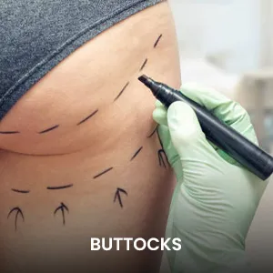 liposuction-buttocks