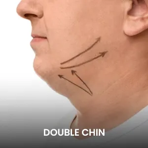 liposuction doublechin