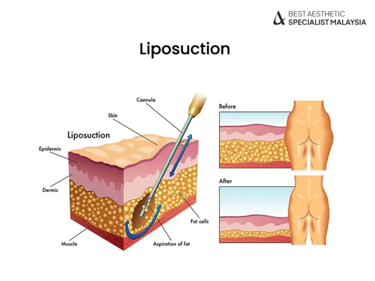 liposuction-surgery-detail