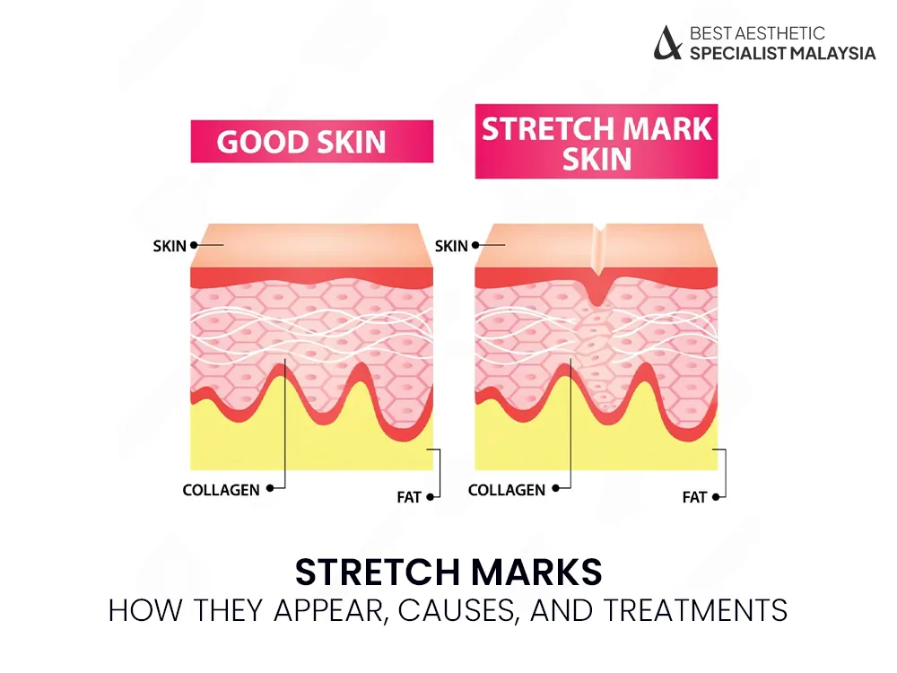 stretch-marks-removal-causes-treatment-1