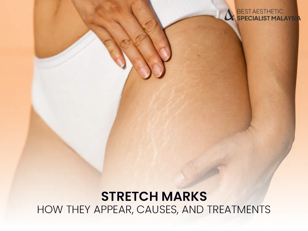 stretch-marks-removal-causes-treatment