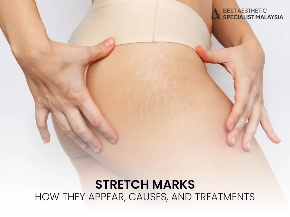 stretch-marks-removal-causes