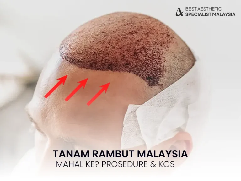 tanam-rambut-malaysia-prosedure-kos-kl