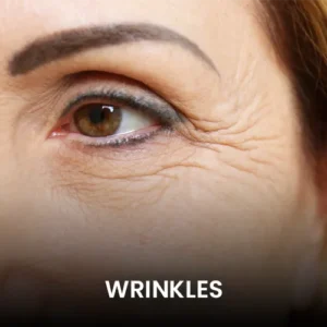 wrinkles-pico-laser