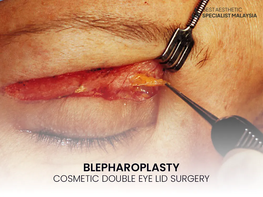 blepharoplasty-cosmetic-surgery