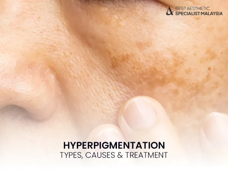 hyperpigmentation-1