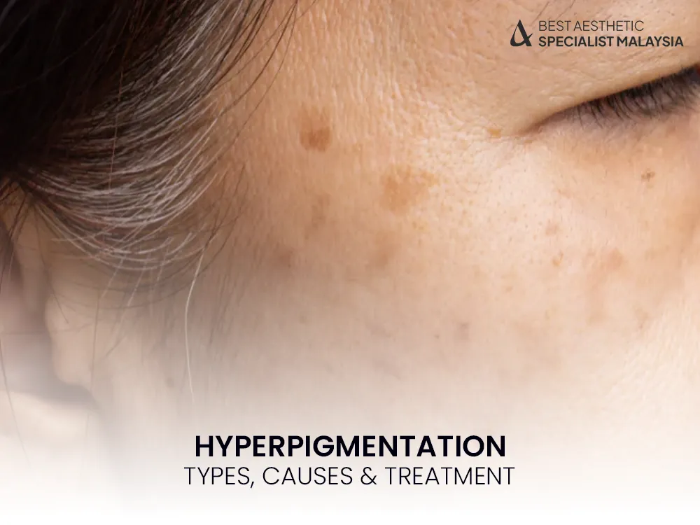 hyperpigmentation