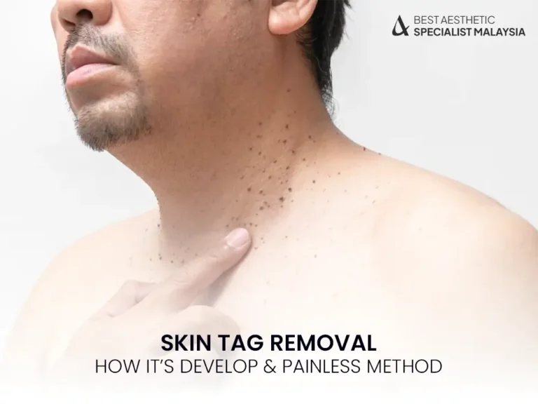 skin-tag-removal-permanent-painless-treatment