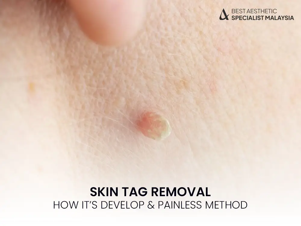 skin-tag-removal-painless-permanent