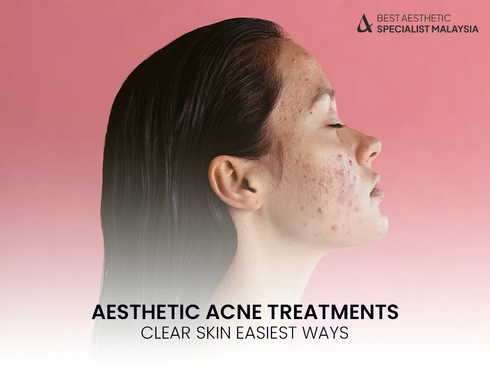 acne-treatments
