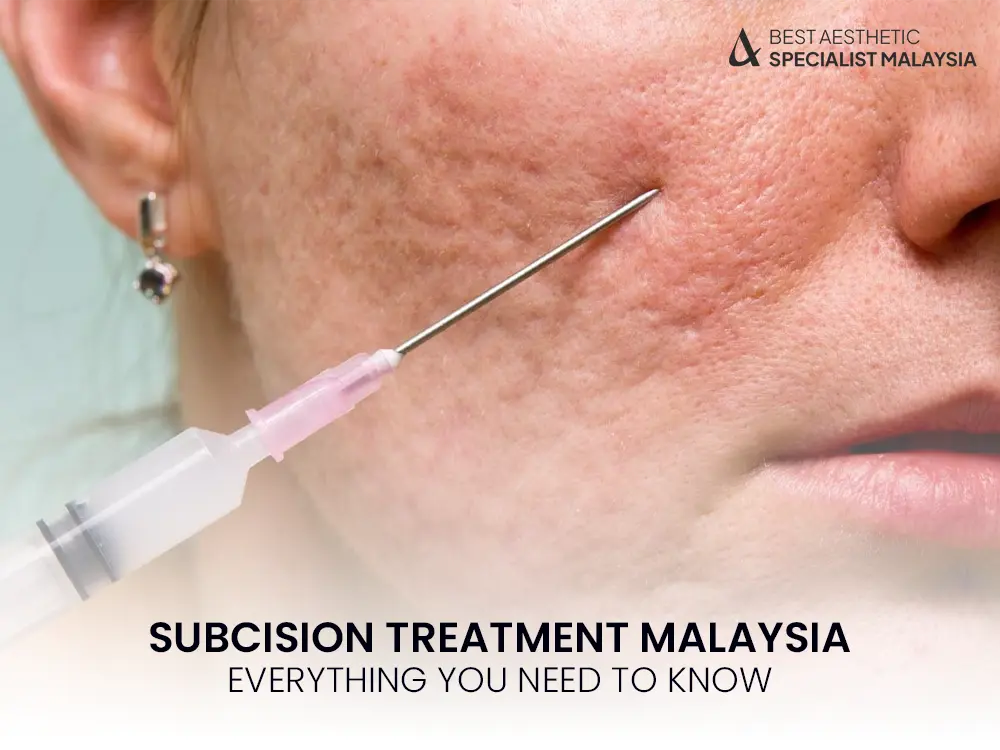 subcision-treatment-malaysia-acne-scars-removal