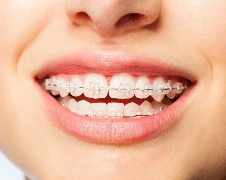 braces-kuala-lumpur