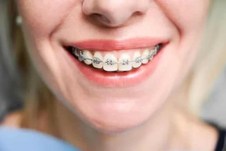 braces-malaysia