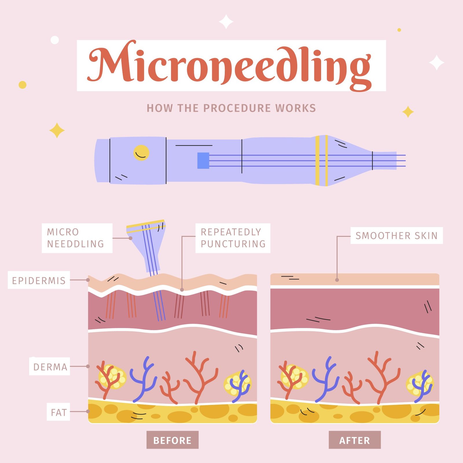 microneedling-treatment
