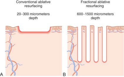 fractional-co2-laser