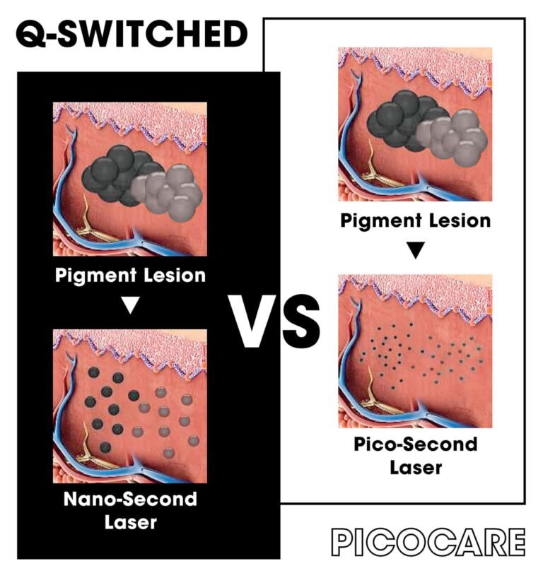 pico-laser-q-switched-laser-comparison