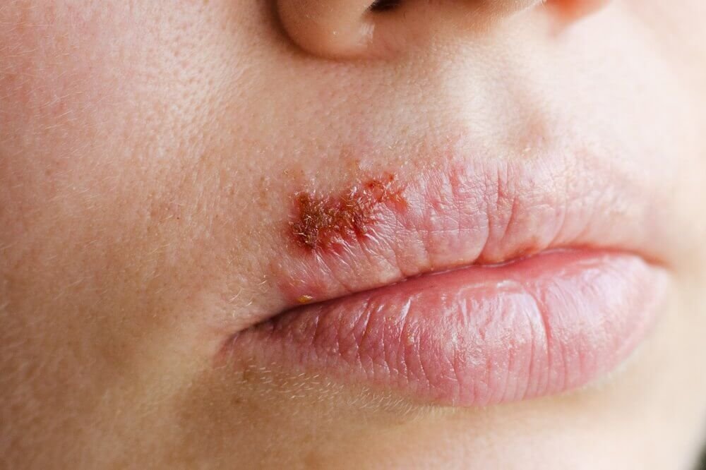 herpes-penyakit-kulit