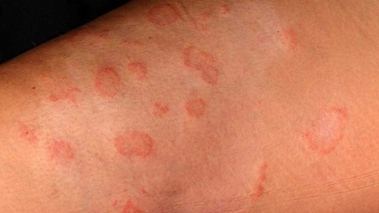 ringworm-penyakit-kulit